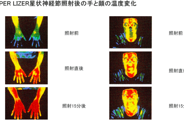 SL照射効果