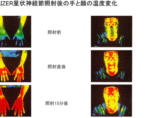 SL照射効果
